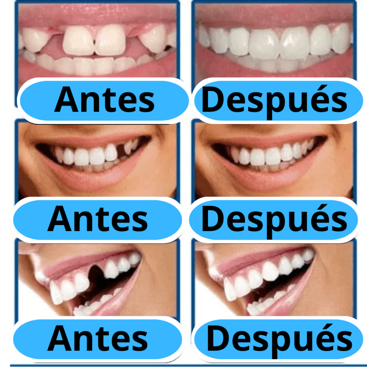 MOLDE DE RESINA PARA DENTADURA